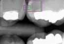 Vědci z FEL ČVUT a 1. LF UK našli způsob, jak s pomocí umělé inteligence spolehlivěji odhalit zubní kazy
